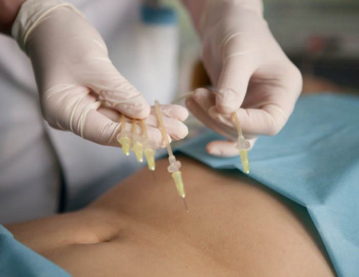 Озонотерапия - Отель Alean Family Sputnik / Алеан Фэмили Спутник